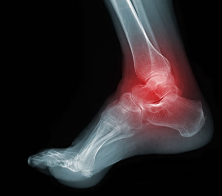 sore ankle